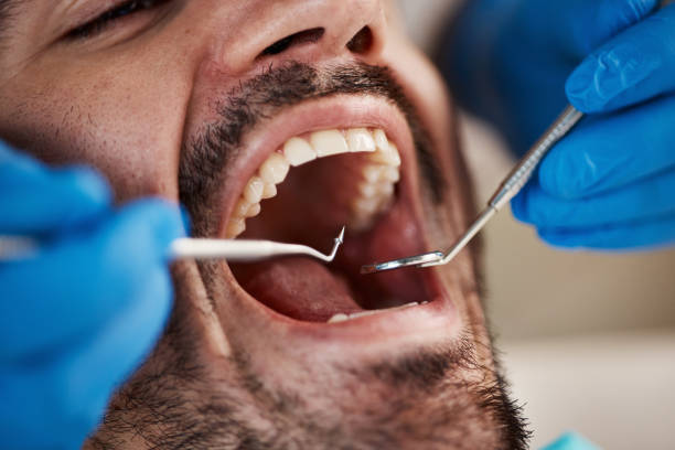 Best Emergency Root Canal Treatment in Milton, DE